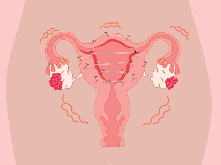 Illustration of women's uterus to represent Endometriosis